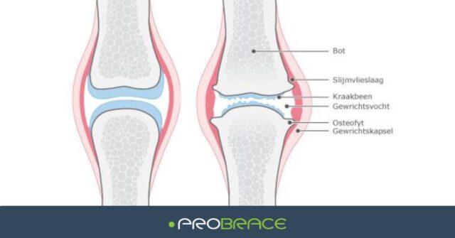 Osteoarthritis What Now Arthritis Support Complaints Pain Blog Information