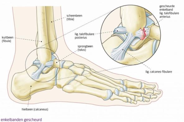 Ankle brace for sales torn achilles tendon