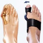 Hallux Valgus Teenbrace