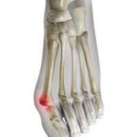 hallux valgus teen brace